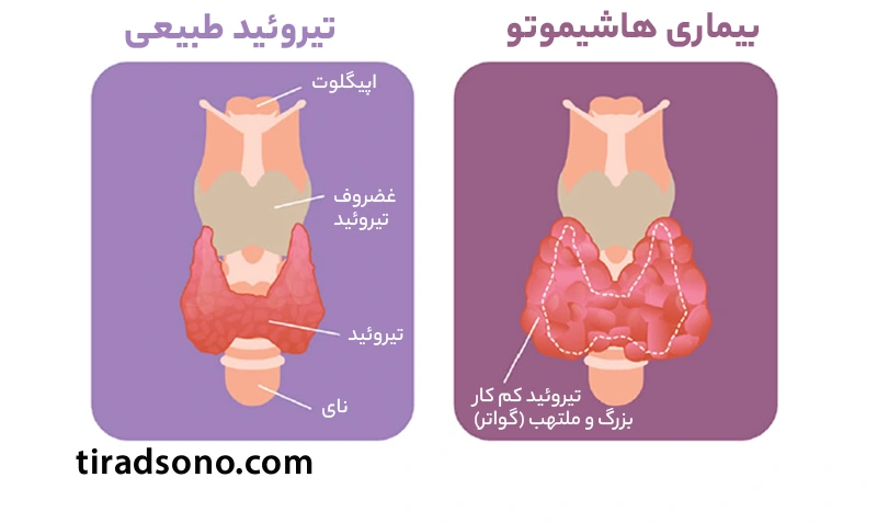 بیماری هاشیموتو