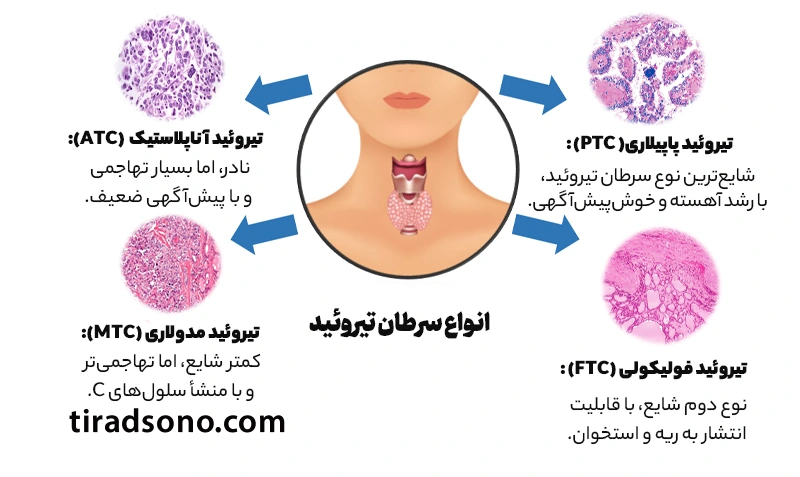 معرفی انواع سرطان تیروئید