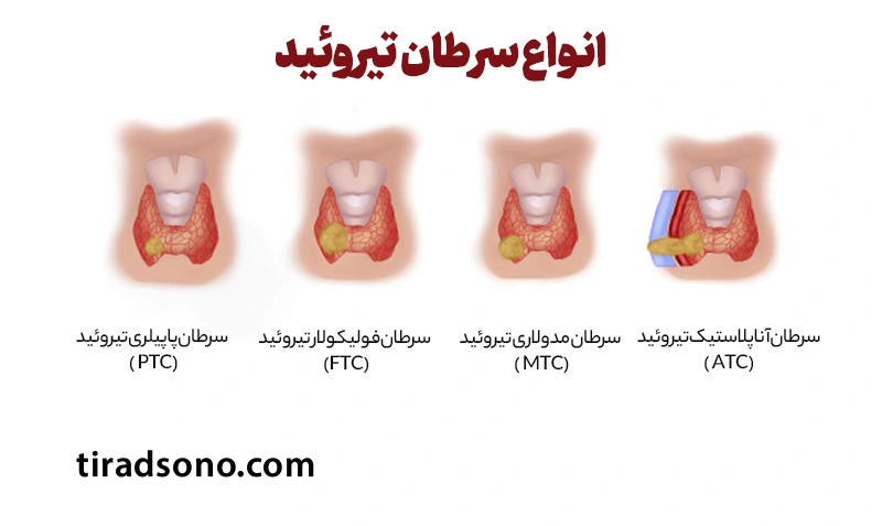 انواع سرطان تیروئید