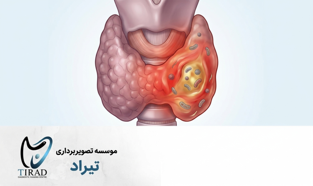 تیروئیدیت عفونی حاد