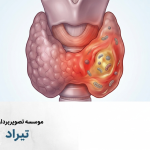 تیروئیدیت عفونی حاد