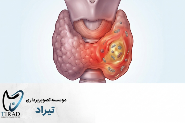 تیروئیدیت عفونی حاد